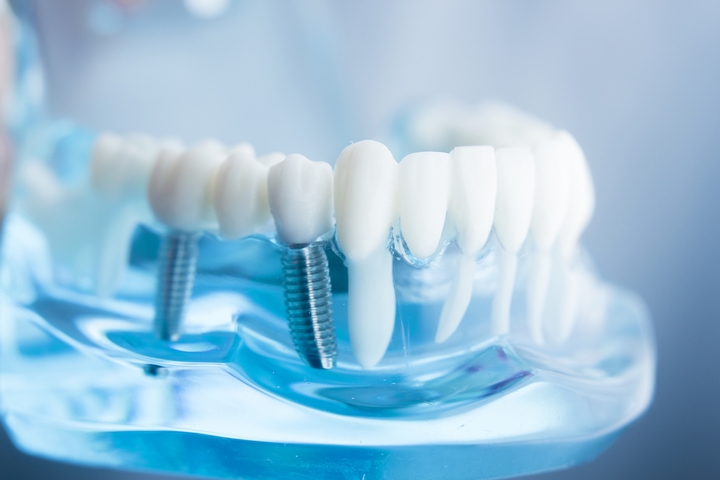 Titanium Power: 3 Benefits of Titanium Dental Implants